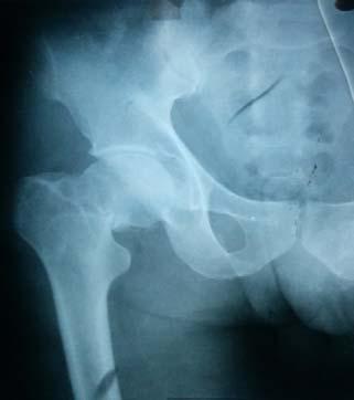 1 Patients with age less than 15 years or more than 60 years. 2. Neglected fracture neck of femur. 3. Patient not willing to undergo surgery. 4.