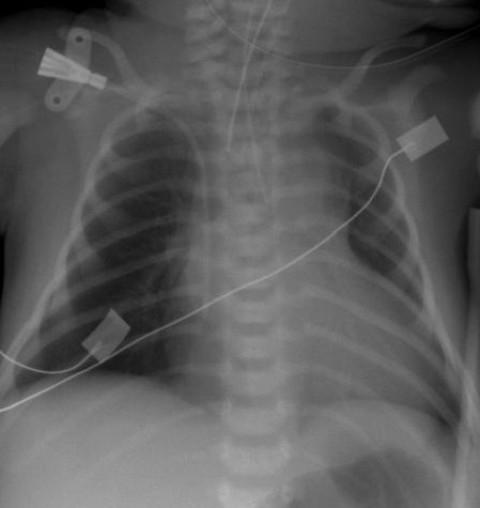 Figure 1 The chest X-ray following intubation shows cardiomegaly
