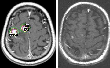 Prophylactic whole brain for stage IIIA/B RTOG 0214 ASTRO 2009 356 patients randomized between WBRT (30 Gy/15 fx) or observation XRT 1-yr DFS 56% 51% 1-yr OS 76% 77% Observation CNS mets