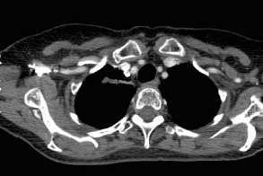RUL mass 1.9 cm CT -> RUL mass 2.3 cm adjacent to prior wedge site. No other disease 87 yo woman 2005 SOB -> RUL mass CXR CT -> RUL  RUL mass 1.9 cm CT -> RUL mass 2.3 cm adjacent to prior wedge site. No other disease 4