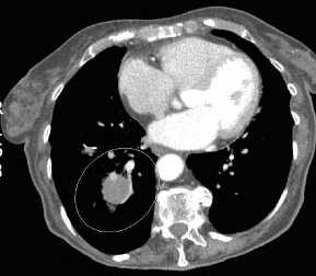 SBRT for lung mets 83 yo woman 2006 Right buttock mass -> leiomyosarcoma Resection and post-operative XRT 2/07 CT -> RUL mass 1 cm 3/07 VATS -> 2