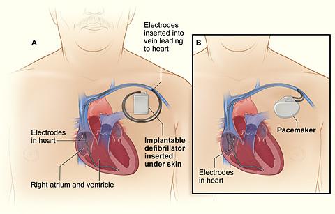 Comparison of an Implantable Cardioverter and a Pacemaker The illustration compares an ICD and a pacemaker. Figure A shows the location and general size of an ICD in the upper chest.