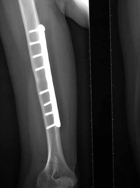 DISCUSSION Medial approaches are rarely used for internal fixation of humeral shaft fractures.