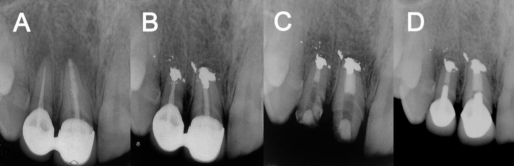 Illustrations Illustration 1 Figure 1 A) Periapical radiograph illustrating periradicular radiolucency after initial root canal therapy; B) Periapical radiograph showing periradicular radiolucency