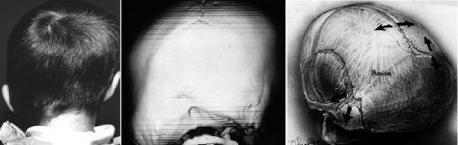 Occipital flattening in the infant skull Kant Y. Lin, M.D.