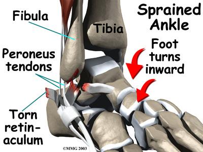 The main cause of peroneal tendon subluxation is an ankle sprain. A sprain that injures the ligaments on the outer edge of the ankle can also damage the peroneal tendons.