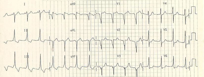The Knee-Jerk Referral: Sinus Rhythm, but Wassup with the QRS s?