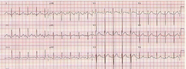 The Knee-Jerk Referral: Sinus Rhythm, but Wassup with the QRS s?
