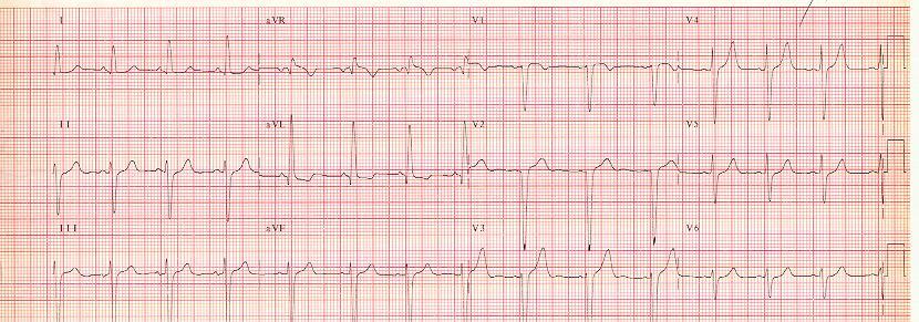 The Knee-Jerk Referral: Sinus Rhythm, but Wassup with the QRS s? 2 year old (QRS=0.