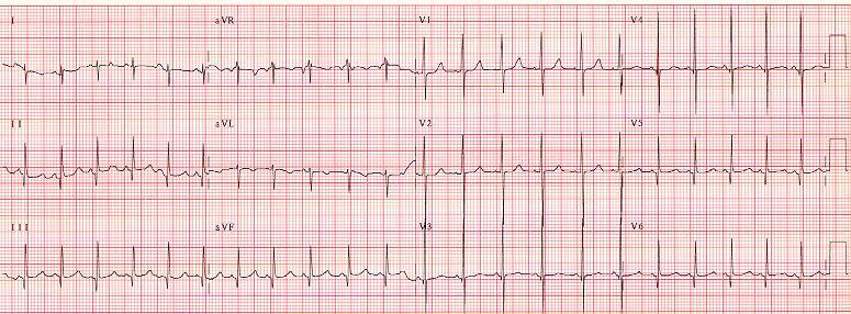 he Knee-Jerk Referral: When ST and T waves Cannot be