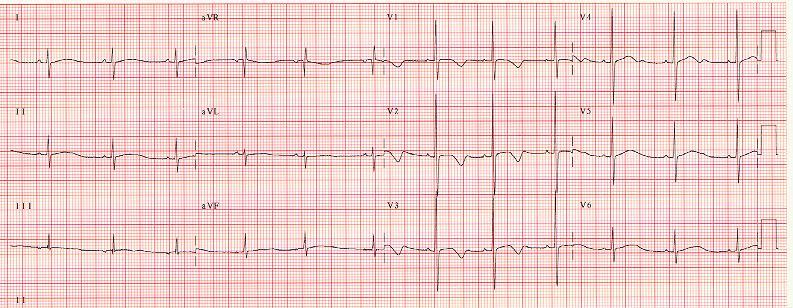 The Knee-Jerk Referral: When ST and T waves Cannot be Ignored 12 year old male with syncope RR=0.85s QT=0.