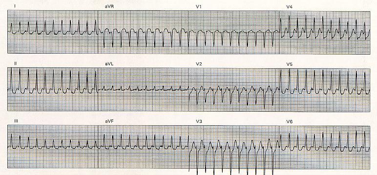 The Knee-Jerk Referral: When Rhythm Gives Us the Blues Supraventricular