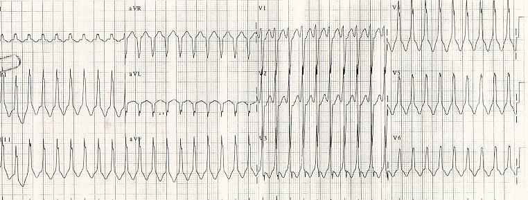 The Knee-Jerk Referral: When Rhythm Gives Us the Blues 6 yr old (QRS=0.