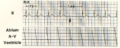 The Knee-Jerk Referral: When Rhythm Gives Us the Blues Note the constant PR interval prior to