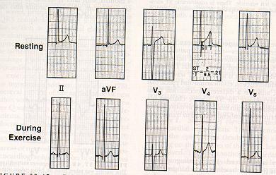 Mind the Milieu and Minimize Mistakes: Shades of Gray J point elevation ( early repolarization