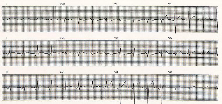 Normal Electrocardiogram Honest Inverted P waves in inferior leads Low atrial rhythm (at