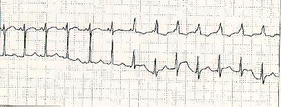 Normal Electrocardiogram Honest Idioventricular rhythm takes