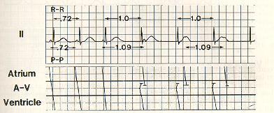Normal Electrocardiogram Honest Second only to sinus arrhythmia, junctional