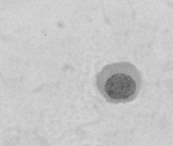 Fig. 1. Spermatogenic cells in the seminal plasma on azoospermic men.