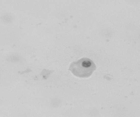 Cytological examination of seminal plasma in cases with azoospermia were studied.