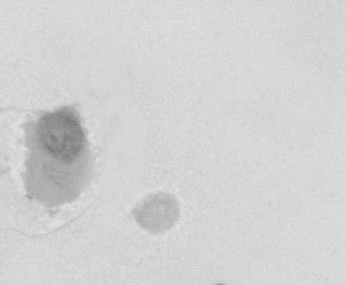 Fig. 2. Nonspermatogenic cells in the seminal plasma on azoospermic men.