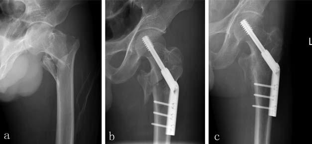 A B C FIGURE 2: Anteroposterior radiographs demonstrating a left pertrochanteric fracture treated with a dynamic helical screw: (A) before surgery; (B) immediately after surgery (first post-operative