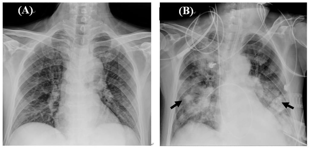 Melioidosis, Splenic Abscess, and Septic Pulmonary Embolism 281 Fig. 1. (A) Chest radiograph on day 1 of admission showing no abnormal infiltrates in the bilateral lungs.