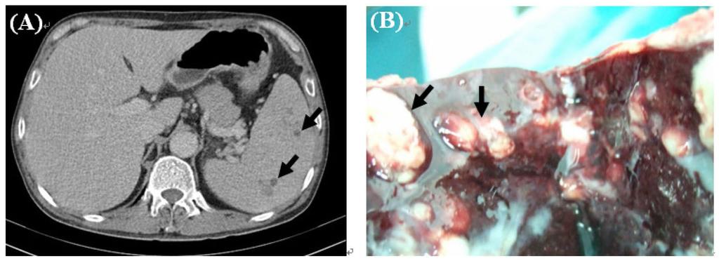 282 Tz-Yan Chang, Yuan-Ti Lee, et al. Fig. 2. (A) Contrast-enhanced abdominal computed tomography in the venous phase showing multiple low attenuation lesions on the spleen (as arrows).