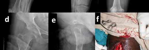 type 3B segmental fracture of the left femur who presented to us 5 days