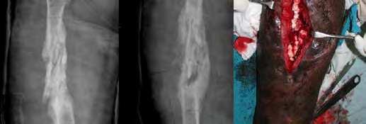 (c): After adequate debridement, the fracture was stabilized with a