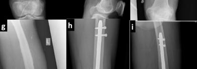 (a): Tc99m MDP bone scan revealed increased tracer activity in the left distal femur suggestive of osteomyelitis.