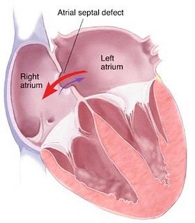 The following murmurs are heard in the aortic area: Aortic stenosis murmur Aortic insufficiency Coarctation of the aorta 3.