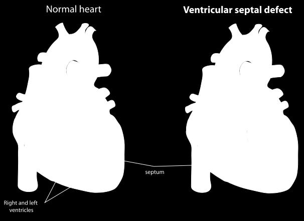 and diastolic pressures. The volume overload of blood in the left atrium and left ventricle lead to increased pulmonary venous engorgement.