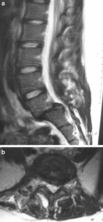 anteroposterior and lateral radiographs of the lumbar spine [4, 5, 10]. However, emergency room radiographs are frequently inadequate and can easily be misinterpreted as normal [4, 5].