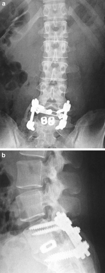 In this case, to avoid pain prior to surgery the patient remained in the lumbar spinal and hip flexion position, and therefore, contracture of soft tissues and the hip joint had not resolved until