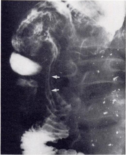 Barium passes through narrowed channel surrounded by coil spring appearance in mid-small bowel. No obstruction. Diagnosis: mid-small bowel intussusception due to Schdnlein-Henoch purpura.