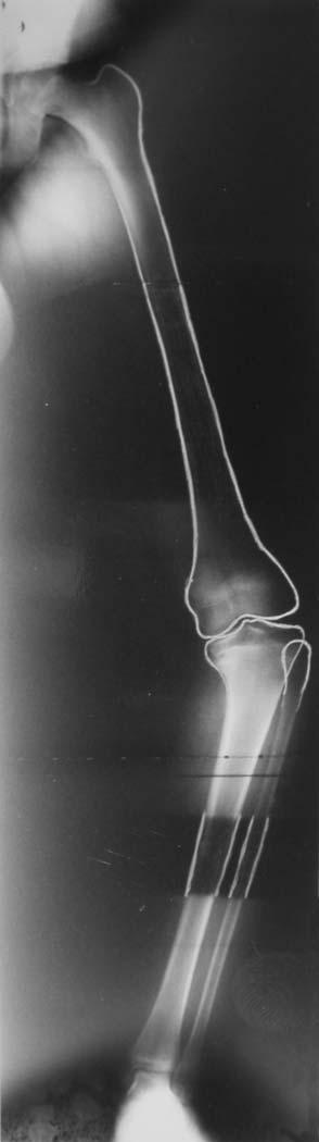 384 unilateral late-onset disease had a mean medial proximal tibial angle of 74 (range, 52 to 81 ), with a mean of 88 (range, 84 to 93 ) on the contralateral side and a mean difference of 14 (range,