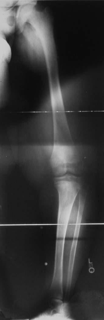 6 Standing anteroposterior radiograph of the left lower extremity of a fourteen-year-old boy with late-onset tibia vara and apparent distal femoral valgus.