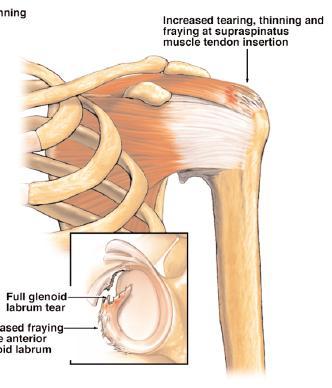 severe injury, such as a partial tear of the muscle and tendon fibres or a complete tear of the tendon that causes the muscle to pull away from the bone. What causes a Rotator Cuff lesion?