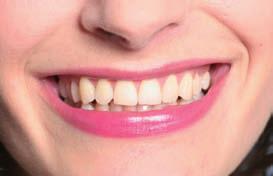 2 hours or 2 45 min 5-12 35 %: daytime, 30 60 min 5-12 POWER WHITENING The fast method of chairside tooth whitening in the dental clinic. 3 15 min (max.