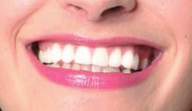 4 15 min) 1 session, in exceptional cases 2 sessions Tips for Tooth Whitening 17 Tips for Tooth Whitening Answers to FAQ before after Which is the best way to offer tooth whitening in my dental