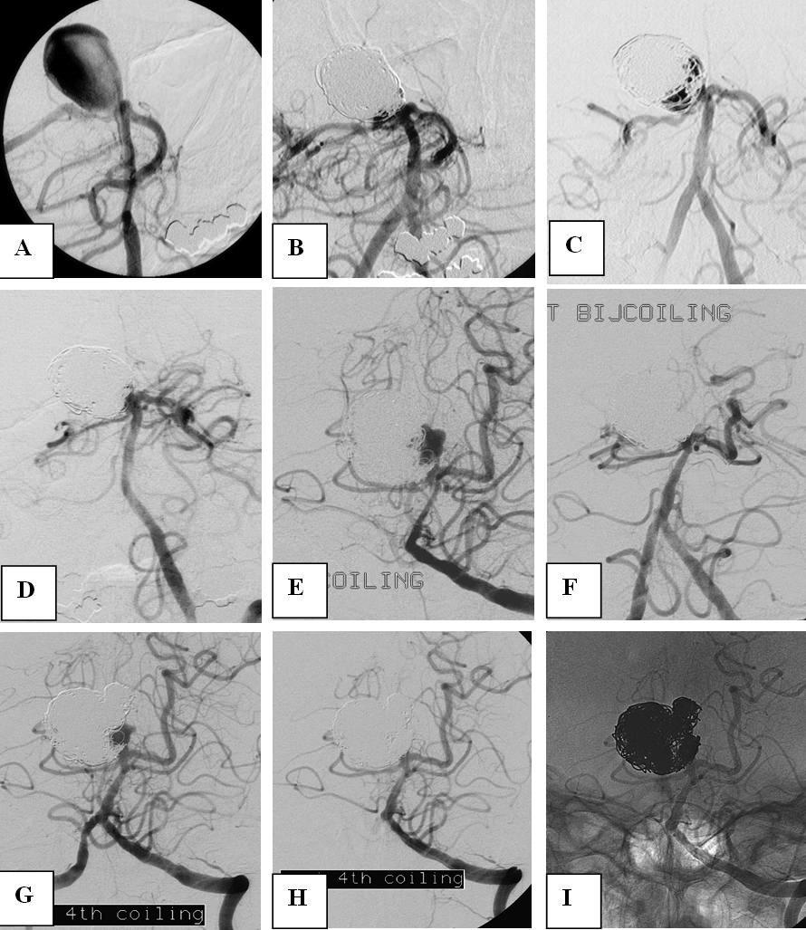 Figure 3 39 year old man (patient # 5) with SAH from giant basilar tip aneurysm in 1996. A: vertebral angiogram shows wide necked giant basilar tip aneurysm. B: complete occlusion after first coiling.