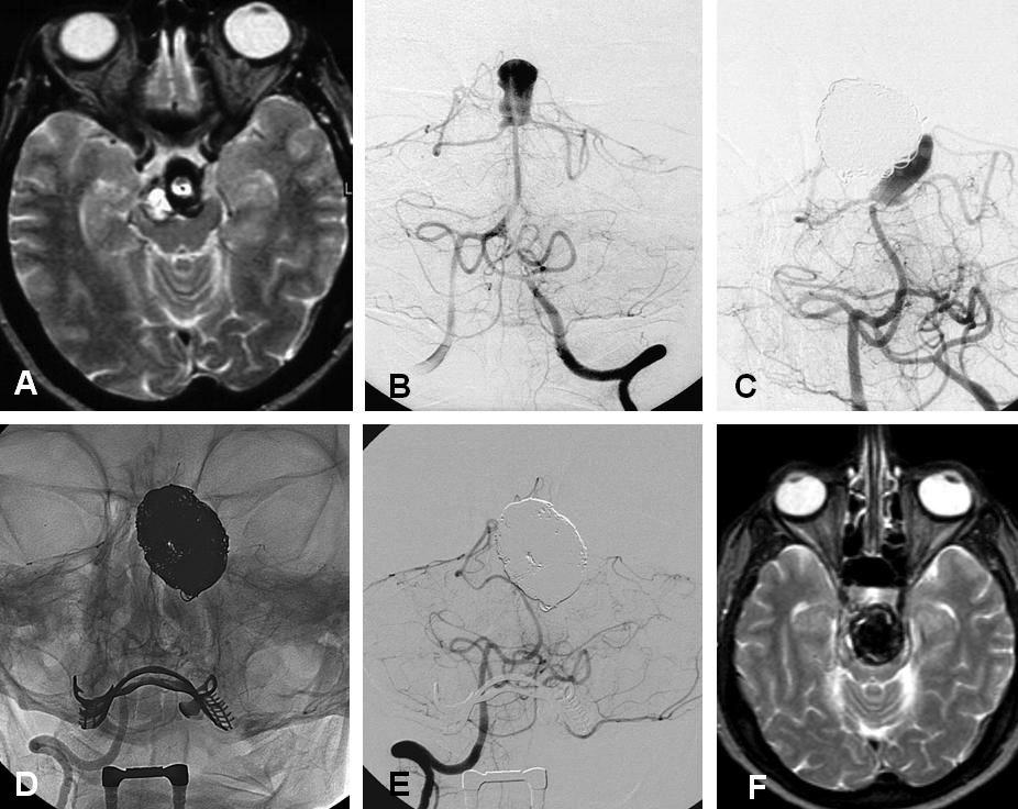 Figure 1 47 year old woman (patient # 8) with an incidentally discovered, partially thrombosed basilar tip aneurysms coiled 6 times in a 6 year period.