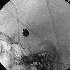 A B C Figure 2 66 year old man (patient # 7) with SAH from a 15 mm anterior communicating artery aneurysm gradually increasing in size at follow up A: coil mesh after first coiling B: coil mesh after