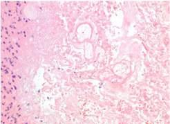 angiocentric glioma, pleomorphic xanthoastrocytoma LOCATION Involvement of corpus callosum (if not necessarily a