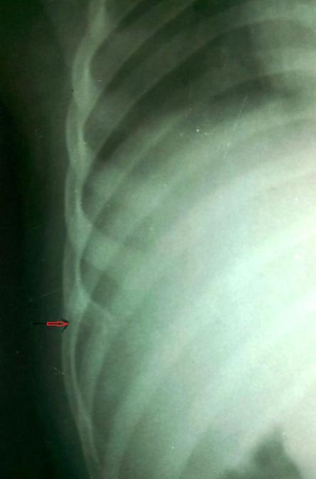 Figure 1. Chest radiograph showed a lytic lesion of the anterior part of the right seventh rib The rest of the lung parenchyma was normal.