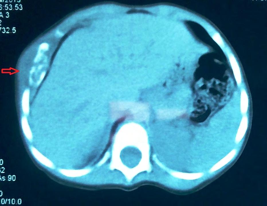 Figure 2. Contrast enhanced computed tomography of the chest showed an expansive lytic lesion involving the anterior part of the seventh rib with cortical erosion and destruction of the same rib.
