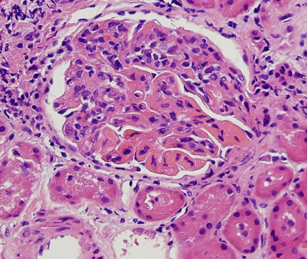 Large glomerular capillary deposits with
