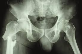 over 50 will fracture due to osteoporosis 4 in 5 women over 67