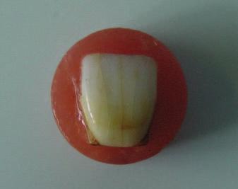 The gel was applied to cover the entire tooth surface at an even thickness, approximately 5 mm.